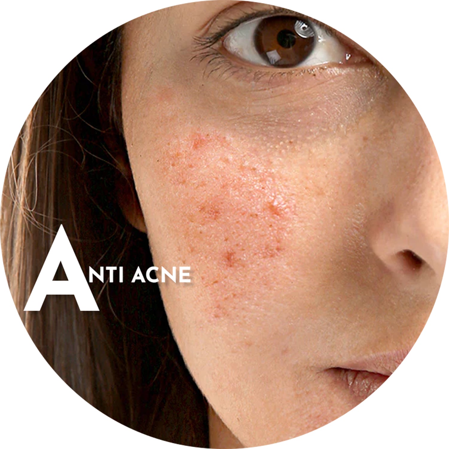 Acne / Pimples