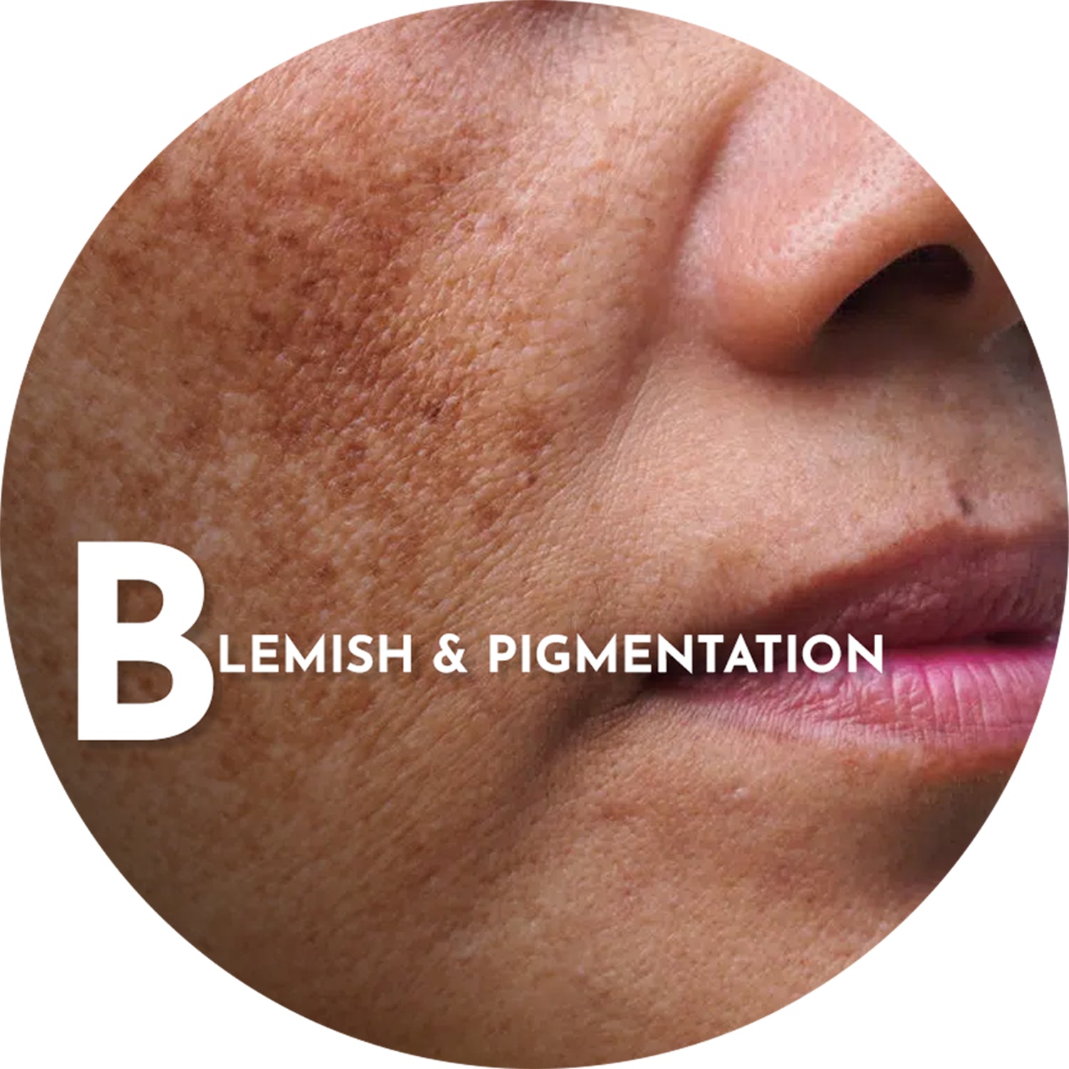 Blemishes / Pigmentation